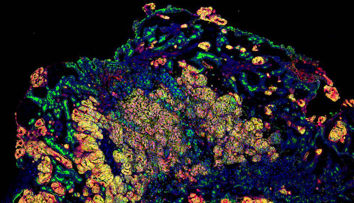 Un proyecto para identificar cuándo empieza la enfermedad que nos puede matar