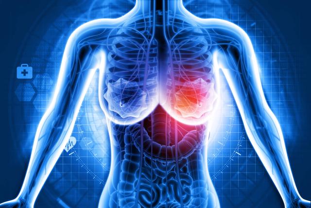 Fármaco multiplica supervivencia en mujeres con cáncer de mama metastásico